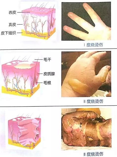 夢見別人燙傷|夢見燙傷的人